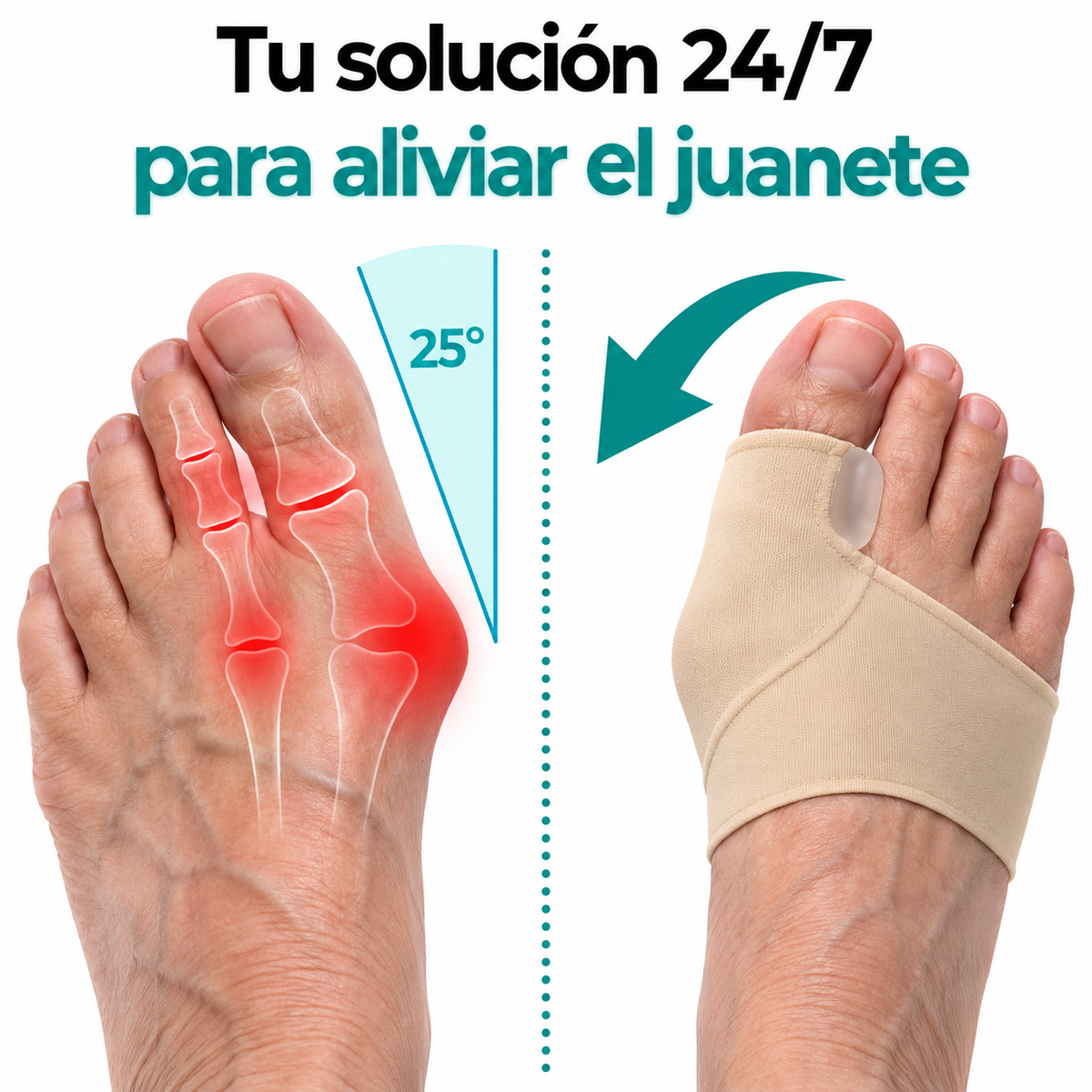 JuanexAlign™ | Realinee su juanete y recupere su vida.