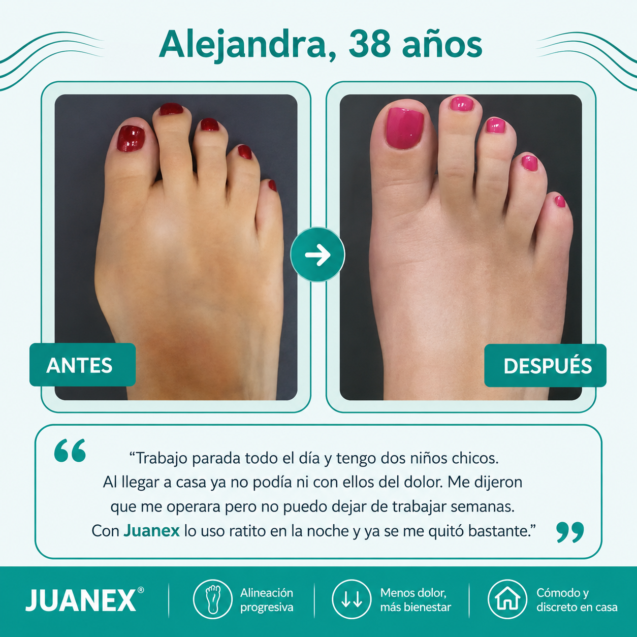 Juanex® | Corrector de Juanetes | ¡PRECIO ESPECIAL 50% OFF!!